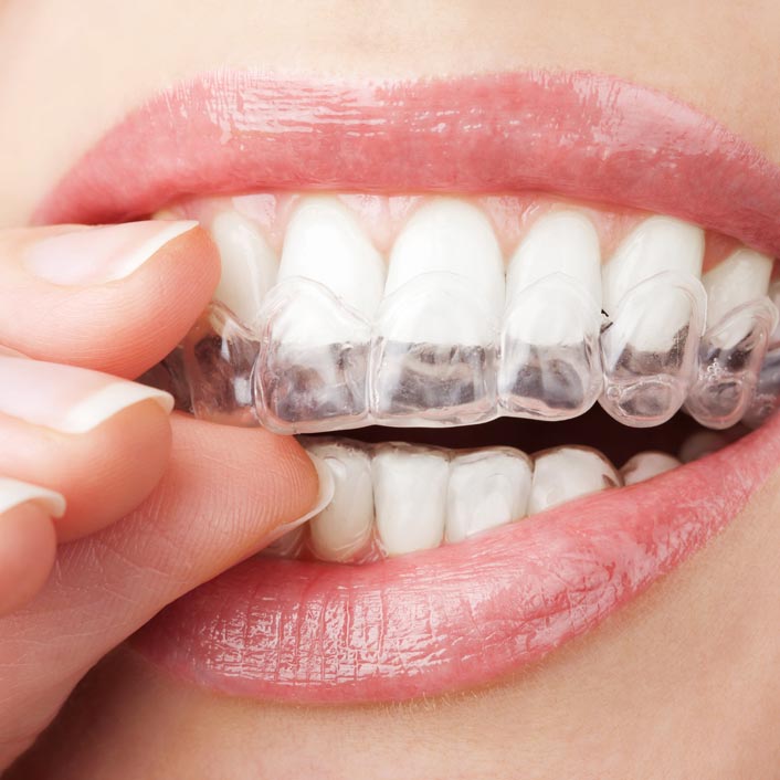 Invisalign clear aligners