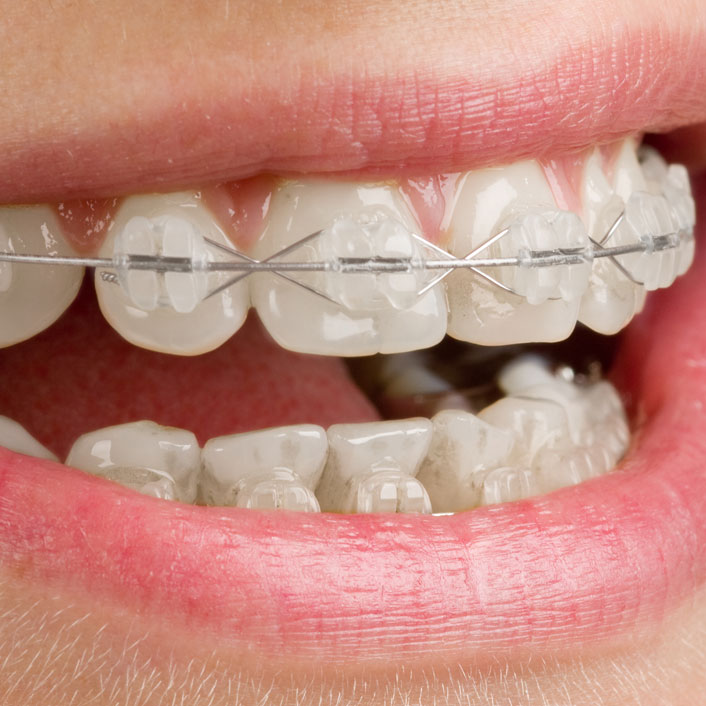 Services - Clear or Tooth-Colored Braces